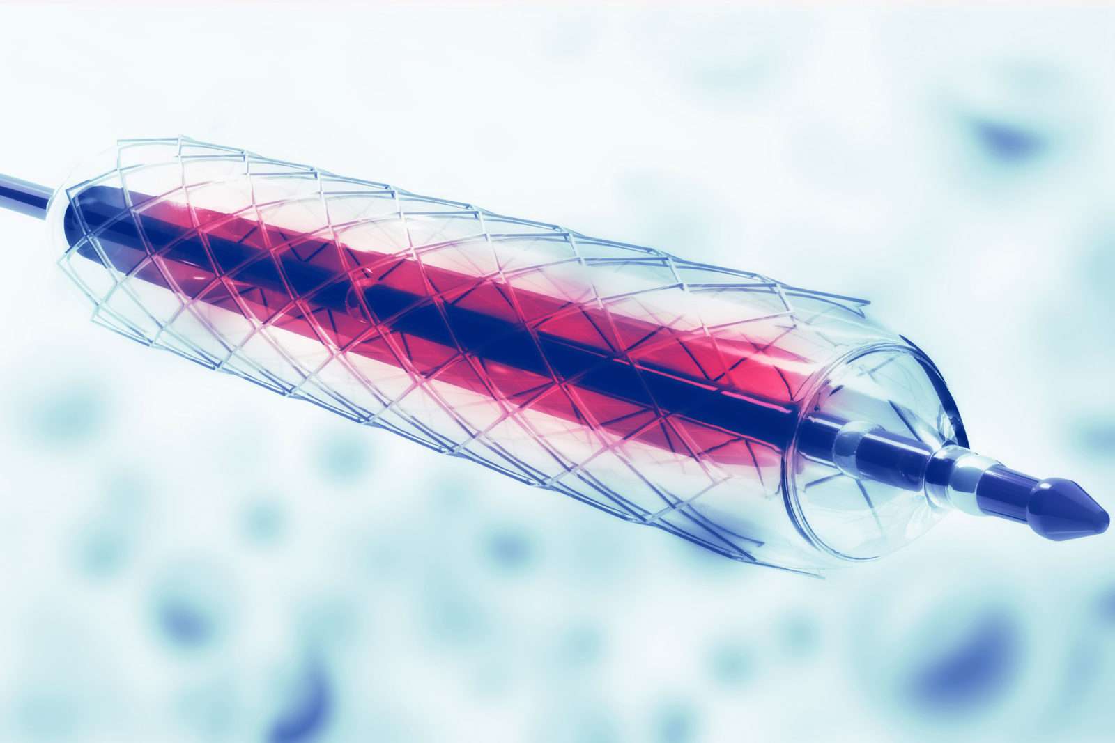 Interventional Cardiology procedures blog article